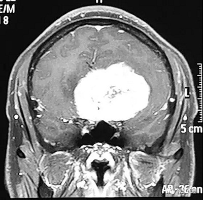视力下降、内分泌紊乱需要查头部磁共振 视力下降、内分泌紊乱需要查头部磁共振
