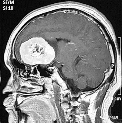 视力下降、内分泌紊乱需要查头部磁共振 视力下降、内分泌紊乱需要查头部磁共振