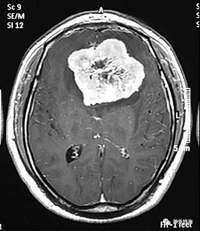 视力下降、内分泌紊乱需要查头部磁共振 视力下降、内分泌紊乱需要查头部磁共振